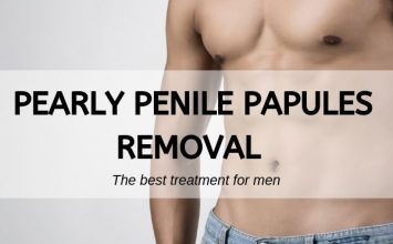 Pearly Penile Papules Removal Review